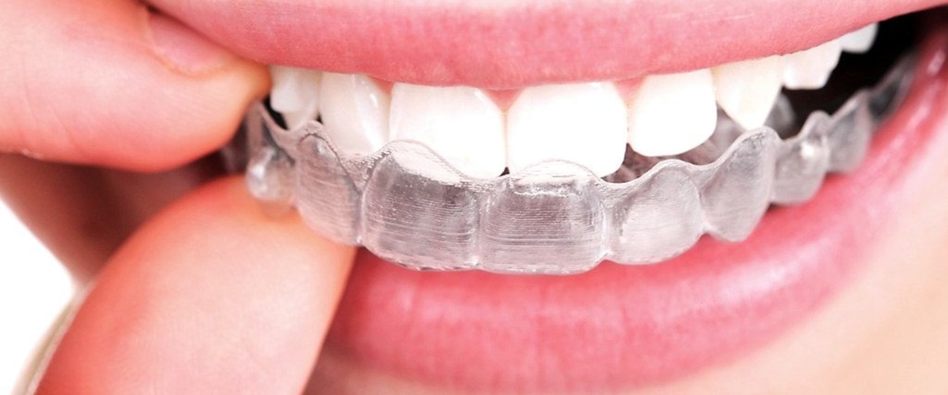 What To Expect During Invisalign Dental Treatment As Part Of Your Preventive Health Care Plan In Texas