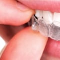 What To Expect During Invisalign Dental Treatment As Part Of Your Preventive Health Care Plan In Texas