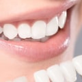 Why Teeth Whitening Is An Important Part Of Preventive Health Care In London