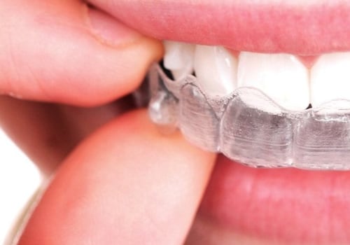 What To Expect During Invisalign Dental Treatment As Part Of Your Preventive Health Care Plan In Texas